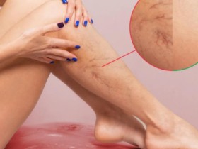 Varicose Veins Treatment